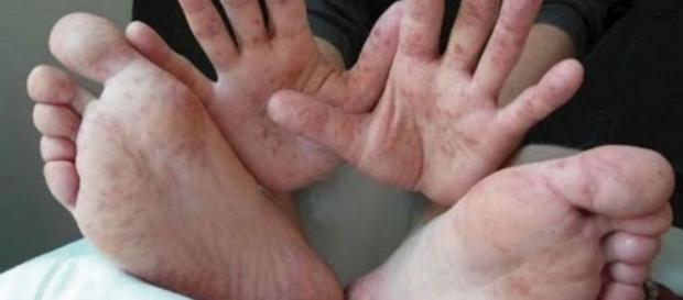 Doença é extremamente contagiosa e comum em ambientes em que há muitas crianças Doença é extremamente contagiosa e comum em ambientes em que há muitas crianças