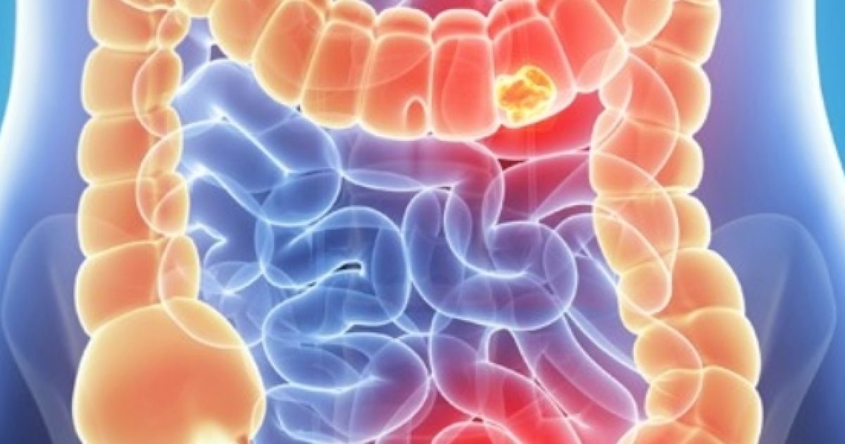 Tumore al colon presto tempi della