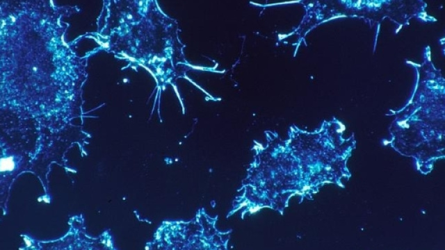 Sarcomi - Ospedale Pediatrico Bambino Ges&ugrave; - ospedalebambinogesu.it