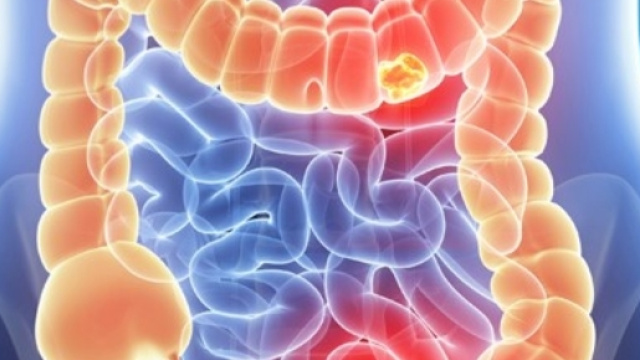 Tumore al colon: tempi della chemioterapia presto dimezzati