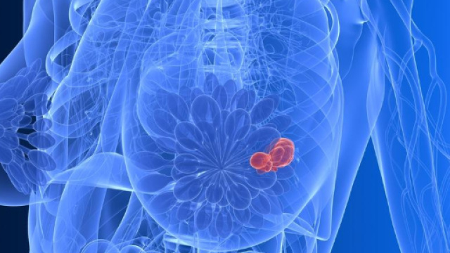 Cancro al seno, i sintomi che devono suscitare preoccupazione