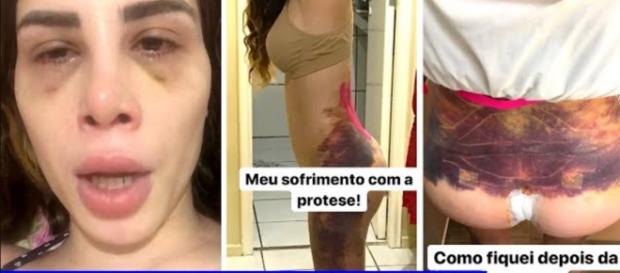 Colocação de prótese foi risco para youtuber. Colocação de prótese foi risco para youtuber.