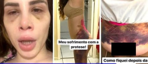 Youtuber Camilla Uckers fica à beira da morte após prótese e fotos chocam