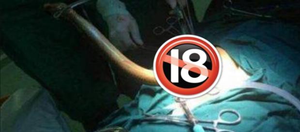 Imagens de cirurgia para retirada de enguia foram publicadas em vídeo no YouTube Imagens de cirurgia para retirada de enguia foram publicadas em vídeo no YouTube