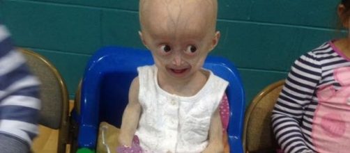 Lucy Parke è morta: malata di Progeria