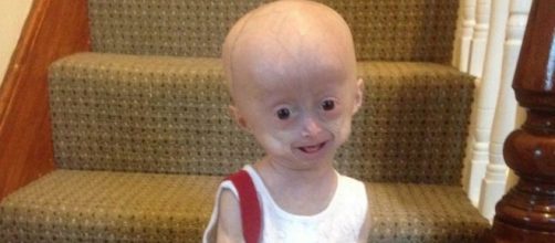 Lucy Parker aveva 8 anni ma sembrava una minuscola vecchina per una rara malattia al momento incurabile. Foto: Facebook.