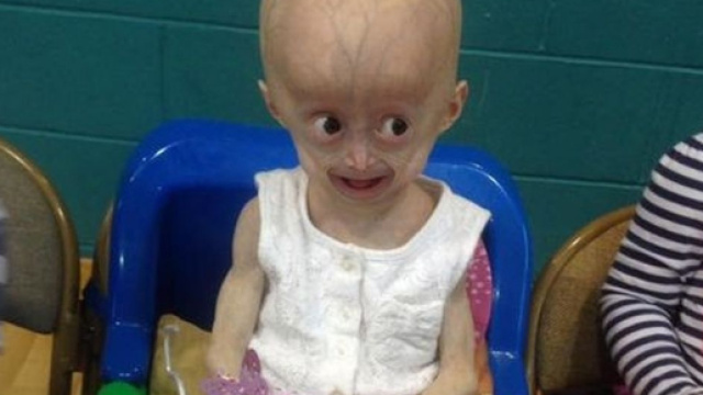 Lucy Parke &egrave; morta: malata di Progeria