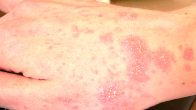 Scabbia in italia: sei le persone contagiate