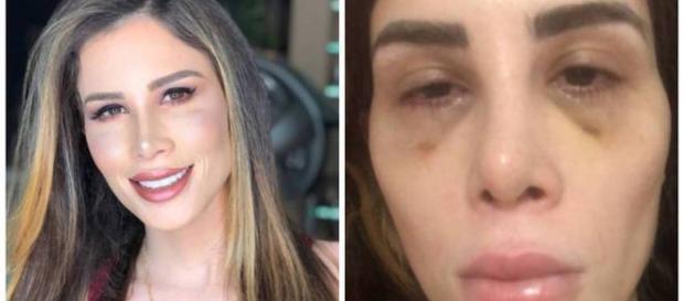 A youtuber Camilla Uckers, antes e após os procedimentos cirúrgicos A youtuber Camilla Uckers, antes e após os procedimentos cirúrgicos