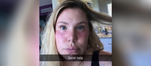 Kailyn Lowry poses with sunburn. [Photo via Snapchat]