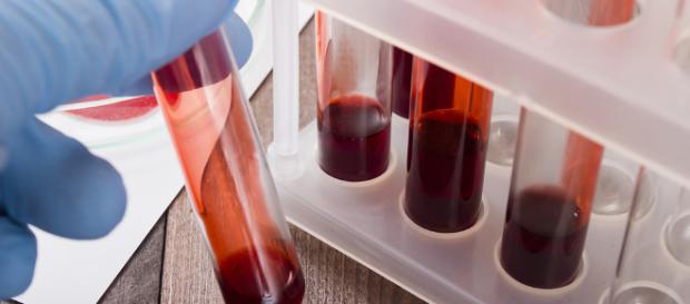 Un análisis de sangre ayuda a detectar un cáncer en su fase ... - mejorconsalud.com Un análisis de sangre ayuda a detectar un cáncer en su fase ... - mejorconsalud.com