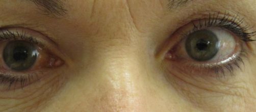 Soffri di Glaucoma? Una persona su due non sa di avere la patologia