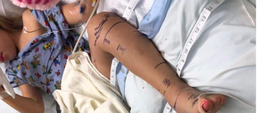 E' in fase di miglioramento la bambina di 5 anni morsa da un serpente a sonagli in Texas.