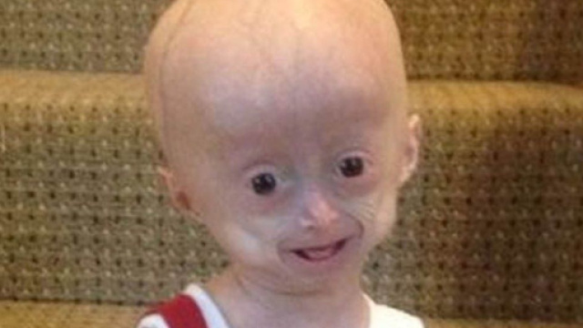 Bambina di 8 anni con il corpo da anziana: la storia di Lucy Parke