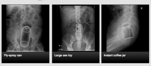 radiografie di corpi estranei nel retto