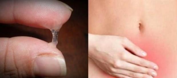 Seu corrimento vaginal está assim? Corra já ao médico Seu corrimento vaginal está assim? Corra já ao médico