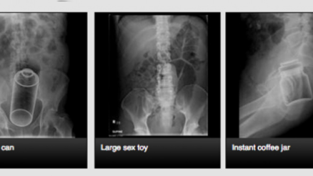 radiografie di corpi estranei nel retto