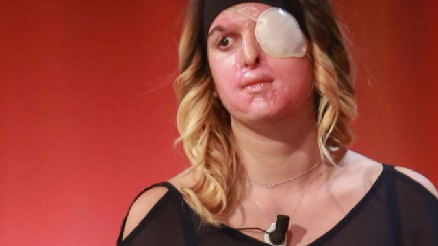 Gessica Notaro a un anno dall'aggressione con l'acido: il coraggio di reagire.