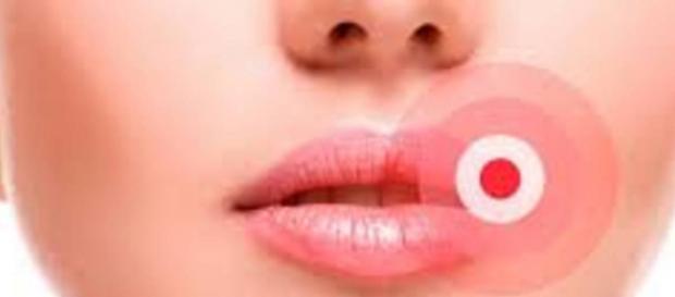 Herpes simplex Typ 1 an der Lippe Herpes simplex Typ 1 an der Lippe