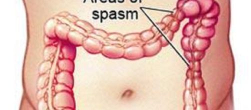 Sindrome del colon irritabile e dieta FODMAP