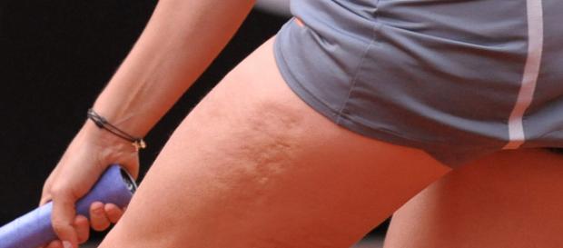 Endo: primo farmaco anti cellulite entro il 2020 Endo: primo farmaco anti cellulite entro il 2020