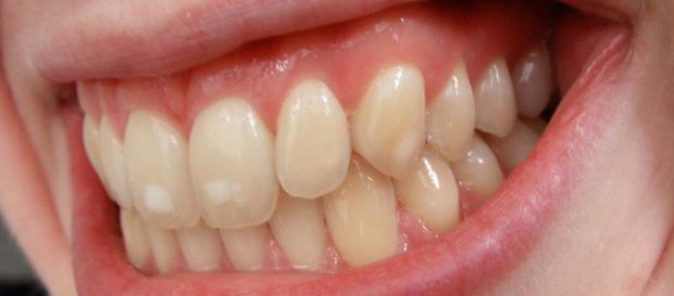 Image of mild dental fluorosis. Image via wikimedia commons. Author: josconklin Image of mild dental fluorosis. Image via wikimedia commons. Author: josconklin