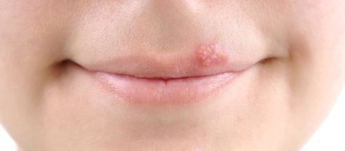 Alcuni consigli per curare l'herpes labiale.