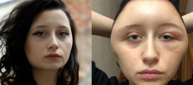 Défigurée après une coloration pour cheveux, Estelle a failli y passer Défigurée après une coloration pour cheveux, Estelle a failli y passer
