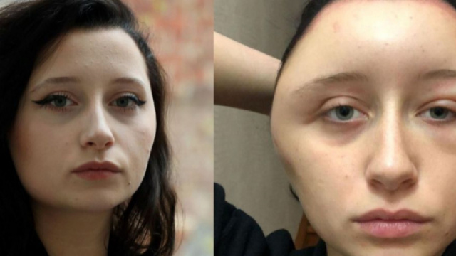 Défigurée après une coloration pour cheveux, Estelle a failli y passer