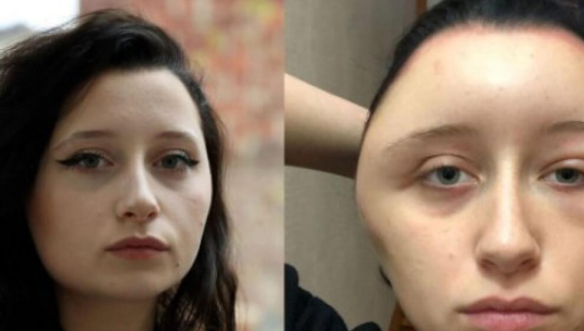 Parigi Rischia Di Morire Per Una Tinta Ai Capelli Reazione Allergica Le Gonfia La Testa