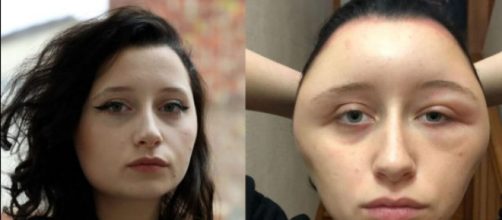 Sta meglio Estelle, la ragazza parigina di 19 anni che ha quasi rischiato di morire per una reazione allergica alla tintura dei capelli.
