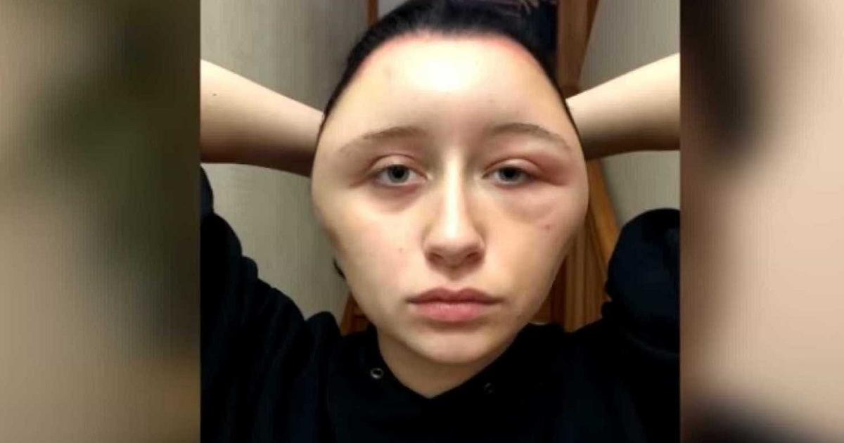 Francia Tintura Capelli Fai Da Te Allergia Ad Una Sostanza Le Gonfia Il Viso Di 63 Cm
