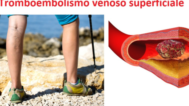 Ci sono varie interventi per prevenire le complicanze da tromboembolismo venoso. Fondaparinux sembra essere la soluzione migliore.