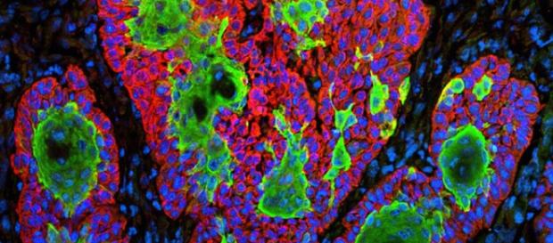 Cellule tumorali della pelle, i primi bersagli dell'immunoterapia Cellule tumorali della pelle, i primi bersagli dell'immunoterapia