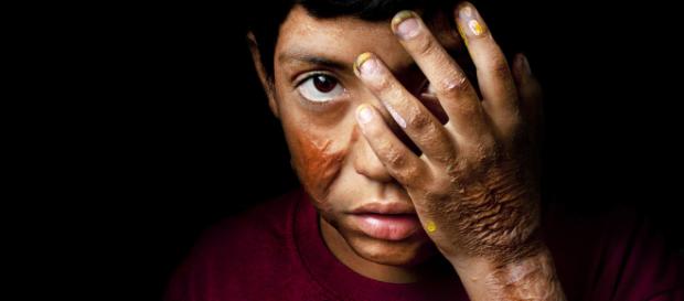 Aplicación con consejos de cómo prevenir las quemaduras en niños. Aplicación con consejos de cómo prevenir las quemaduras en niños.