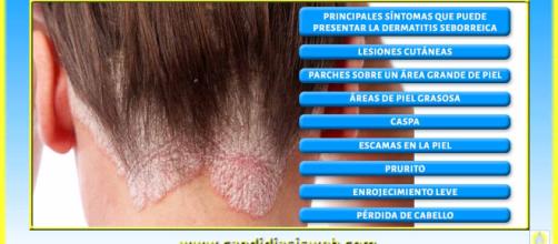 Huracán proyector Accesible Remedios naturales contra la dermatitis seborreica
