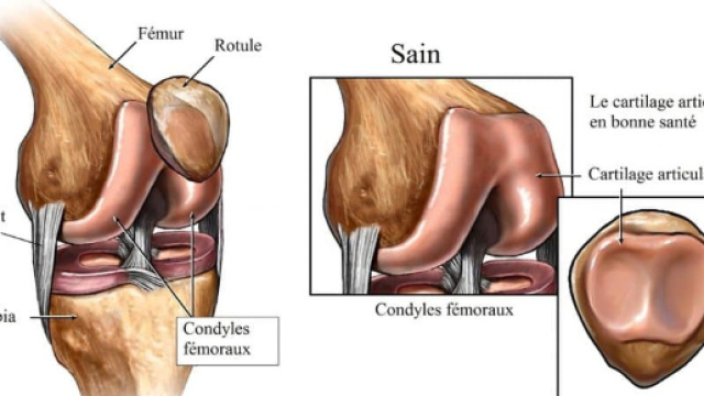 Arthrose du genou, sympt&ocirc;mes et traitement naturel - physiotherapiepourtous.com