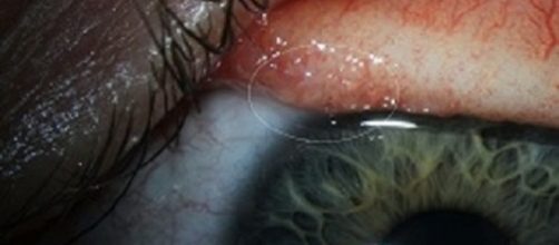 Estratti 14 vermi dall'occhio. La cause della terribile infezione.