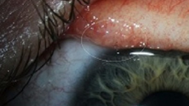 Estratti 14 vermi dall'occhio. La cause della terribile infezione.