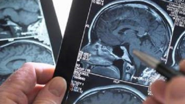 Ictus, scoperti nuovi rischi che lo possono innescare