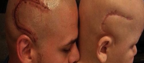 Anime gemelle: Josh Marshall, papà di Gabe morto ieri a 9 anni di tumore al cervello, si era tatuato la stessa cicatrice in testa.