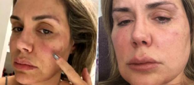 Renata foi espancada pelo marido e ficou deformada Renata foi espancada pelo marido e ficou deformada