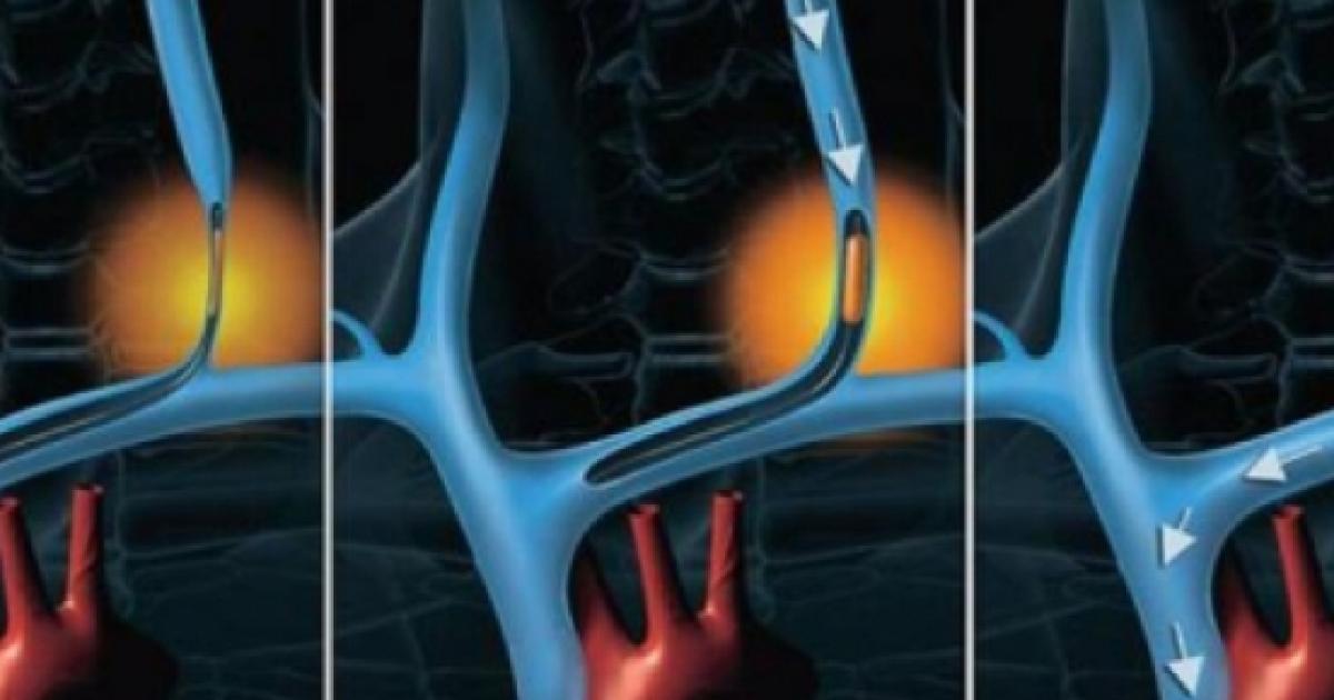 Sclerosi multipla: ora la mielina si può riparare, ecco come