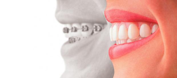 O que são dentes e quais são suas características fundamentais? O que são dentes e quais são suas características fundamentais?