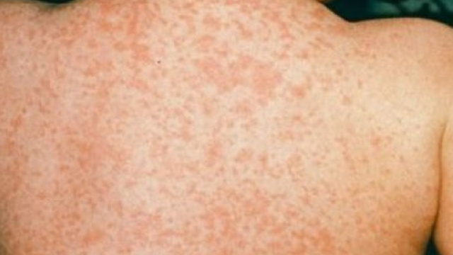 Vicenza, tre fratellini hanno morbillo: &laquo;non sono vaccinati&raquo; | Vvox - vvox.it