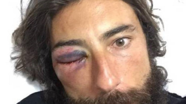 Vittorio Brumotti era gi&agrave; stato pesantemente aggredito