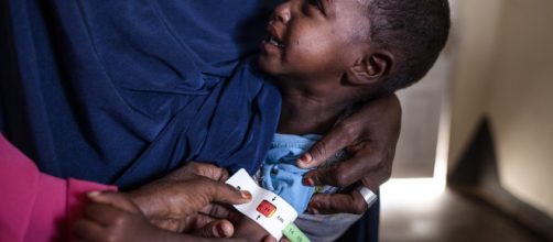 In Somalia, l'Organizzazione Mondiale della Sanità stima che 383.000 bambini sotto i cinque anni soffrono di malnutrizione acuta.