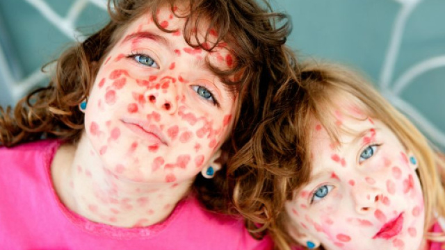 Morbillo in Italia: numeri preoccupanti.