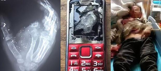 O dedo indicador direito de Meng Jisu foi arrancado na explosão de seu celular (Crédito: AsiaWire) O dedo indicador direito de Meng Jisu foi arrancado na explosão de seu celular (Crédito: AsiaWire)