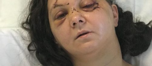 La donna vittima del brutale pestaggio dopo i primi interventi